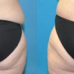 Lower Body Lift #13 - Before and After