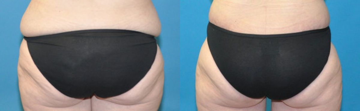 Lower Body Lift #13 - Before and After