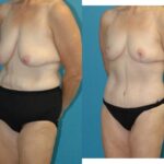 Lower Body Lift #15 - Before and After
