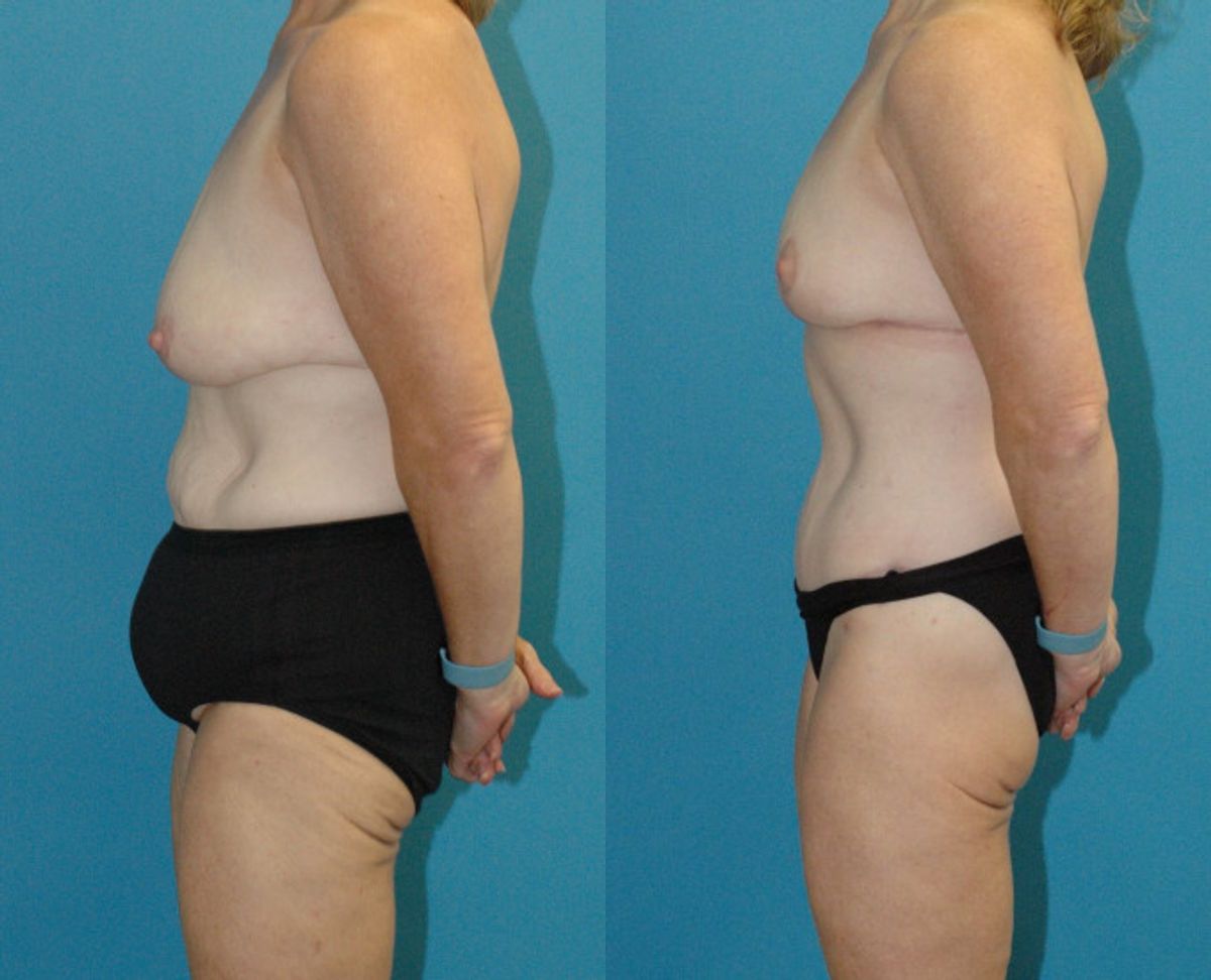 Lower Body Lift #15 - Before and After