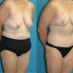 Lower Body Lift #15 - Before and After