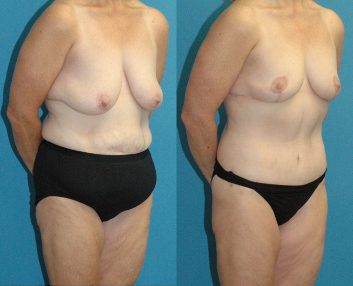 Lower Body Lift #15 - Before and After