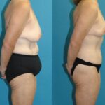 Lower Body Lift #15 - Before and After