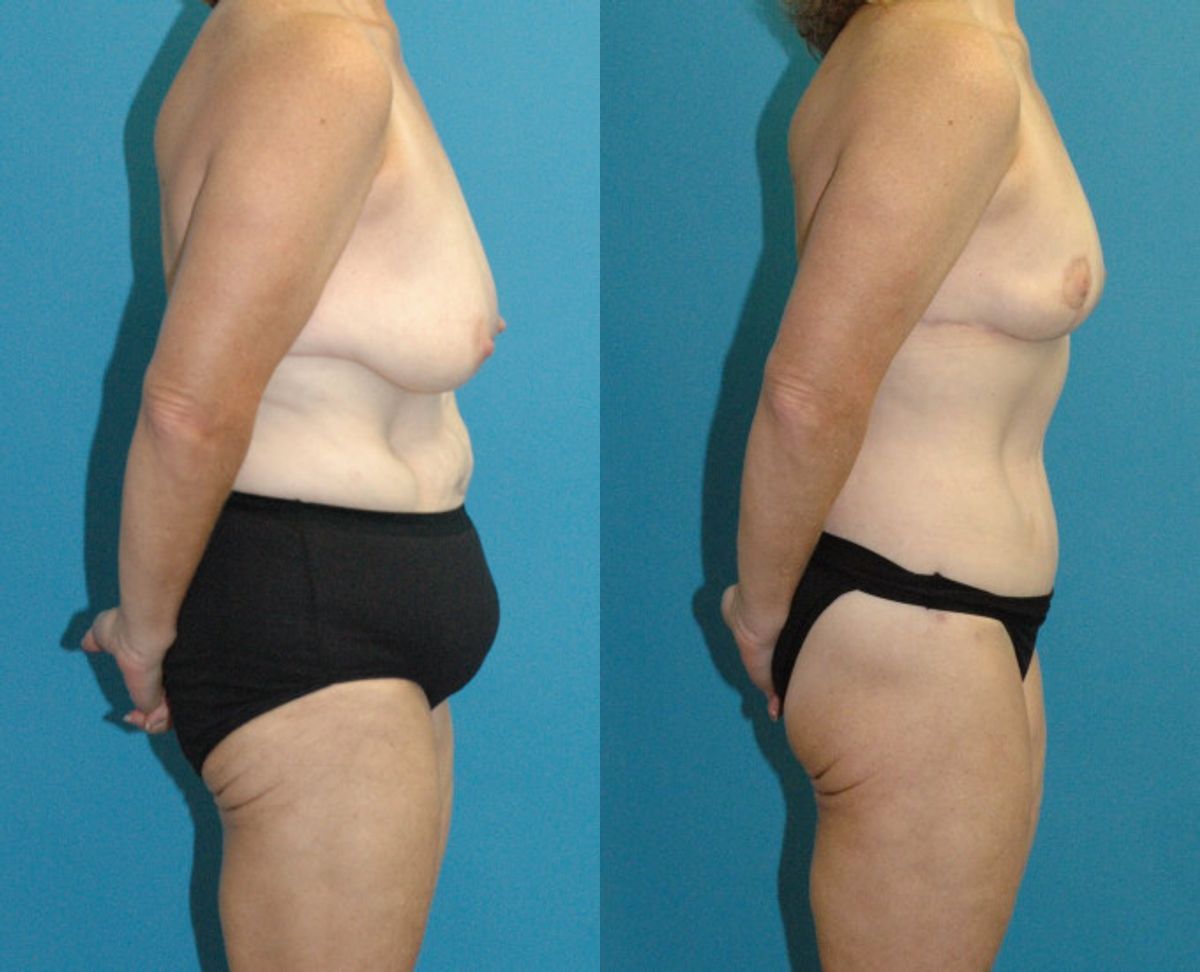 Lower Body Lift #15 - Before and After