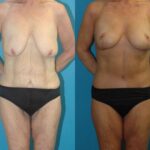Lower Body Lift #16 - Before and After
