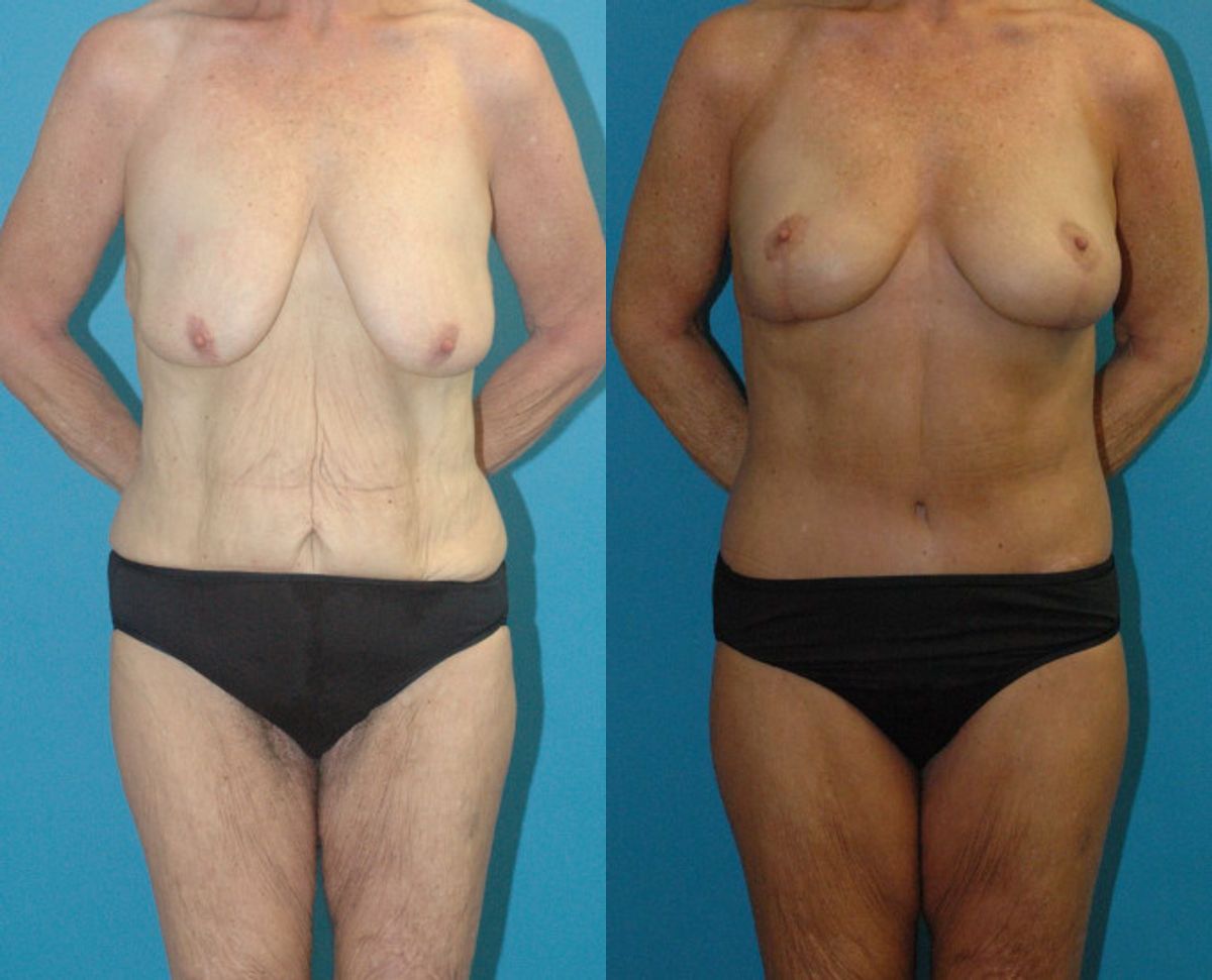 Lower Body Lift #16 - Before and After