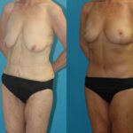 Lower Body Lift #16 - Before and After