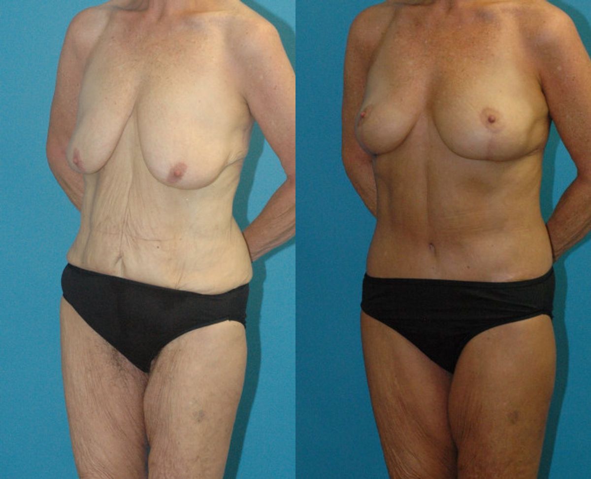 Lower Body Lift #16 - Before and After