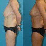 Lower Body Lift #16 - Before and After