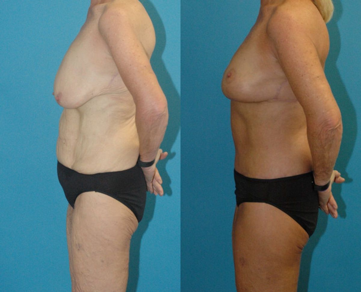 Lower Body Lift #16 - Before and After