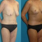 Lower Body Lift #16 - Before and After