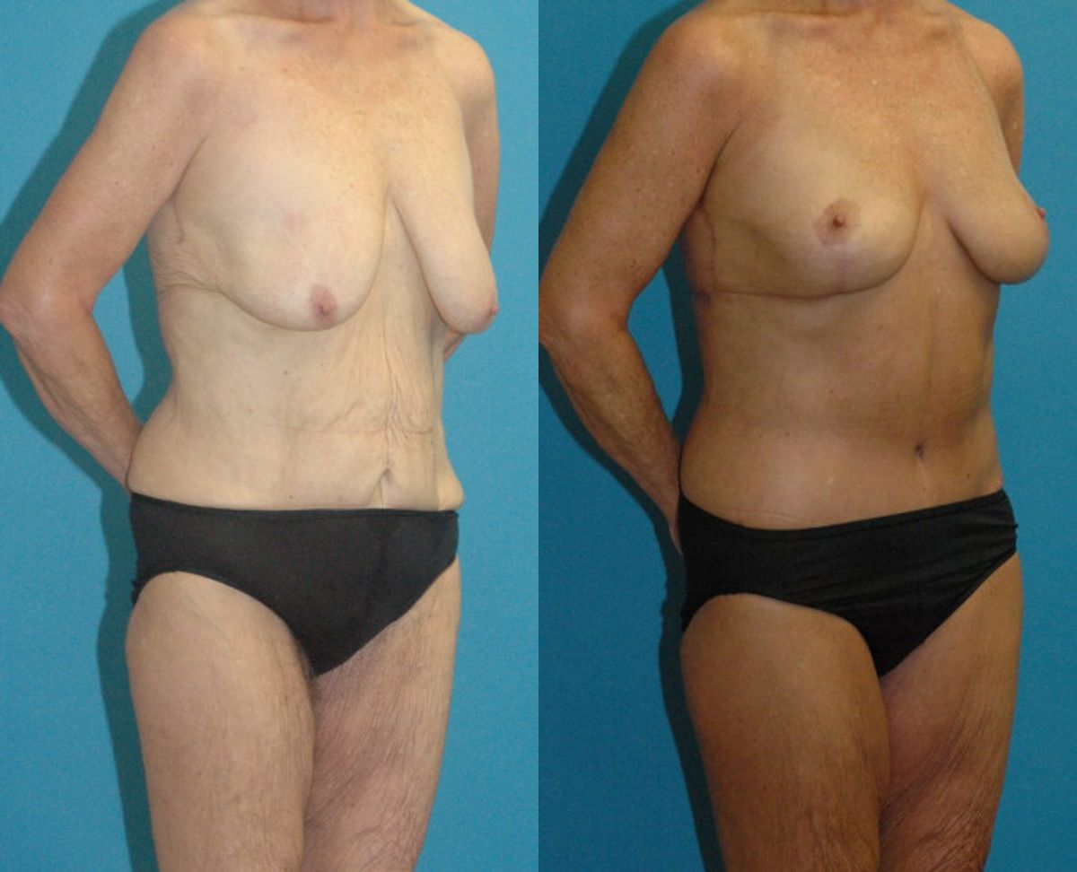 Lower Body Lift #16 - Before and After