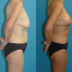 Lower Body Lift #16 - Before and After