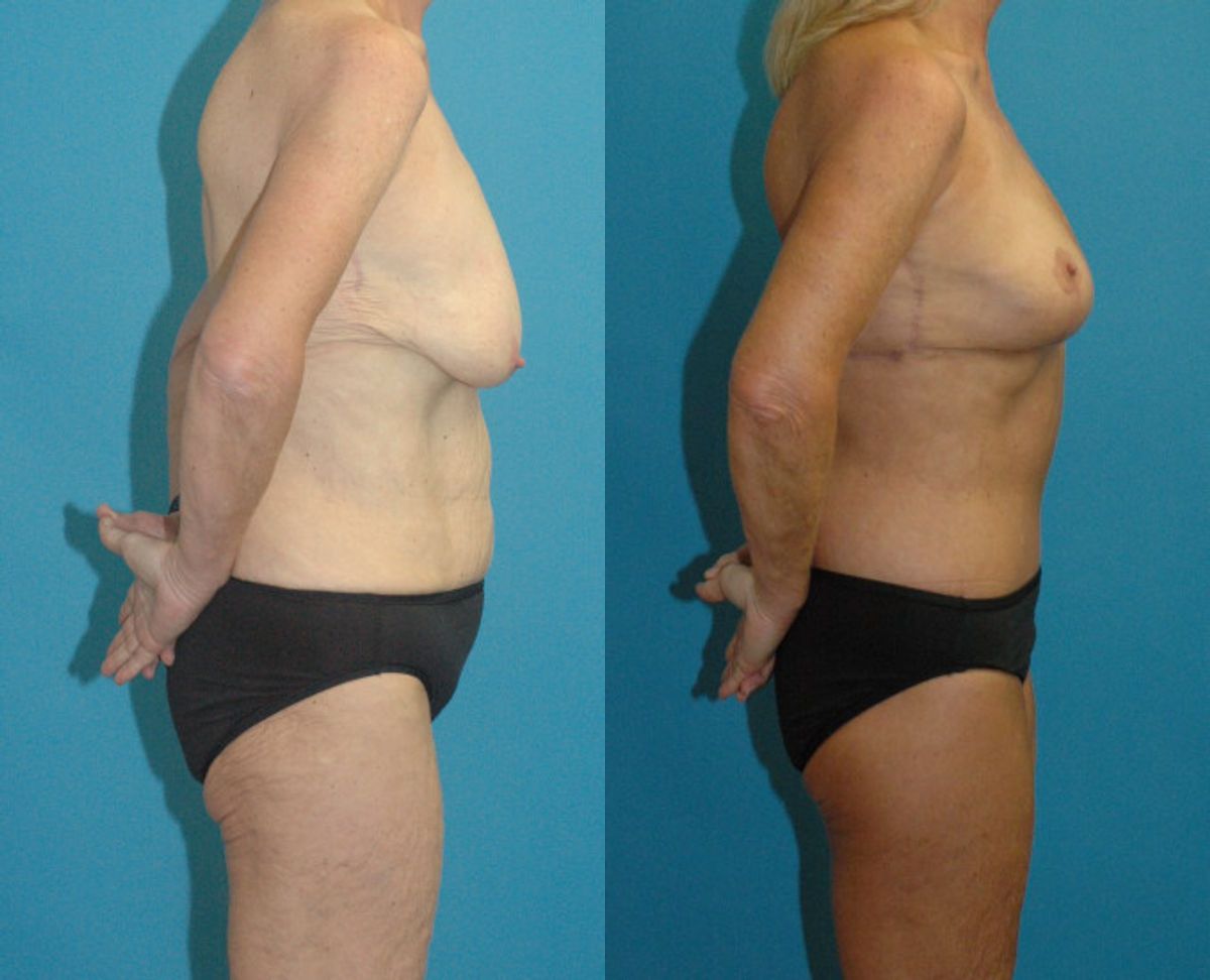 Lower Body Lift #16 - Before and After