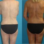 Lower Body Lift #16 - Before and After