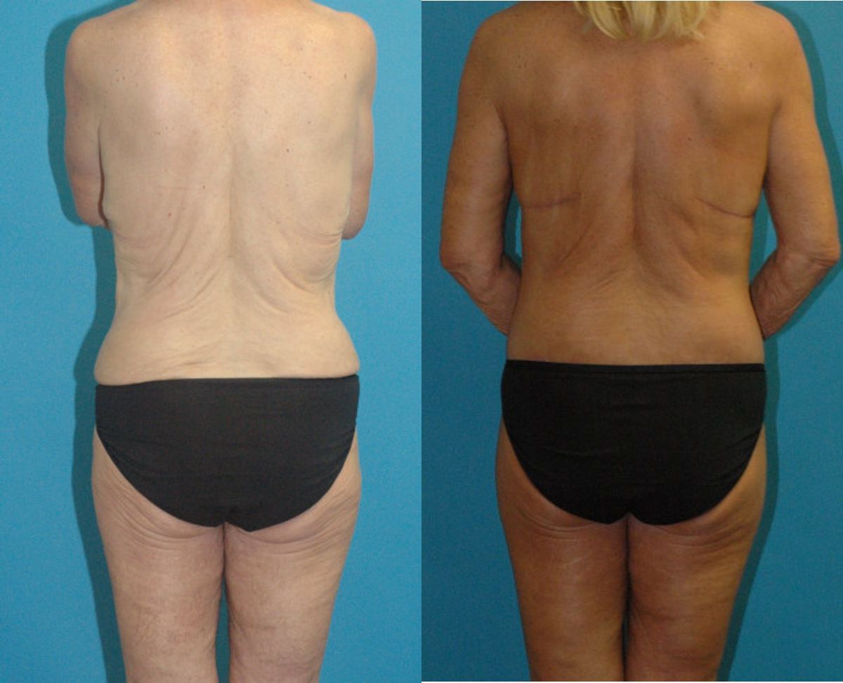 Lower Body Lift #16 - Before and After
