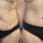 Lower Body Lift #17 - Before and After