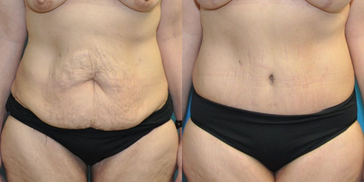 Lower Body Lift #17 - Before and After