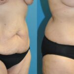 Lower Body Lift #17 - Before and After