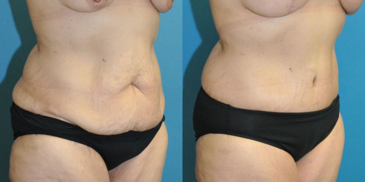 Lower Body Lift #17 - Before and After