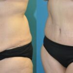 Lower Body Lift #17 - Before and After