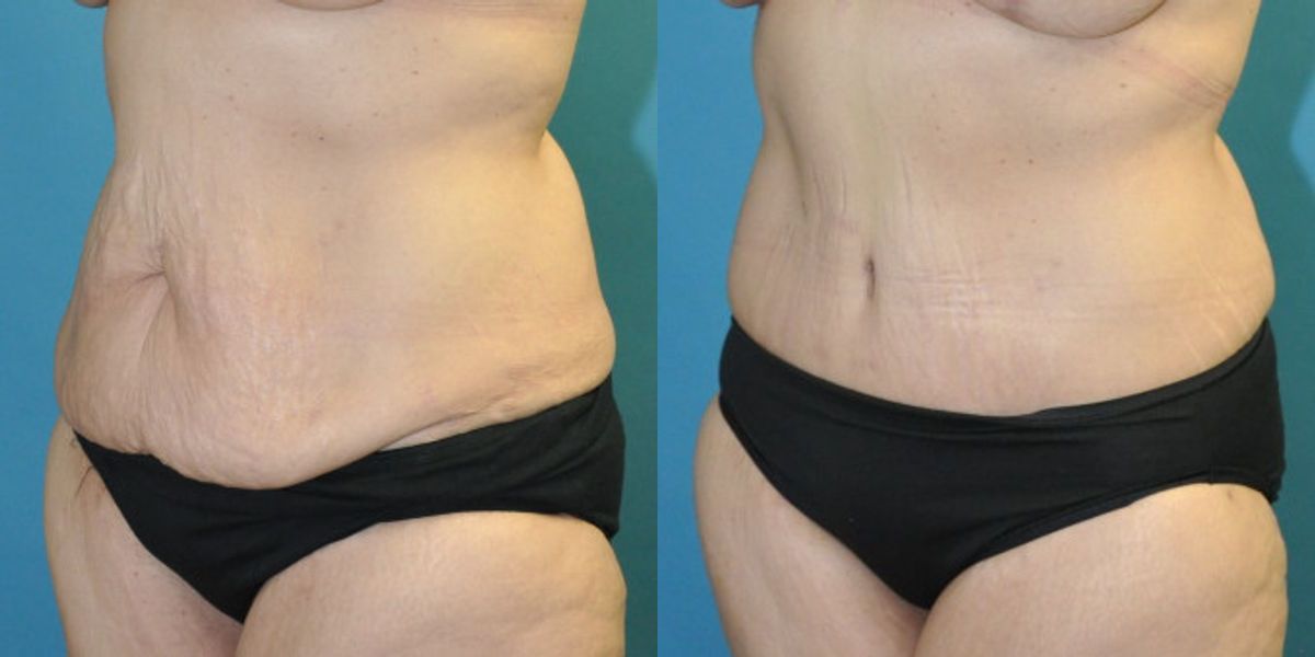 Lower Body Lift #17 - Before and After