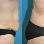 Lower Body Lift #17 - Before and After