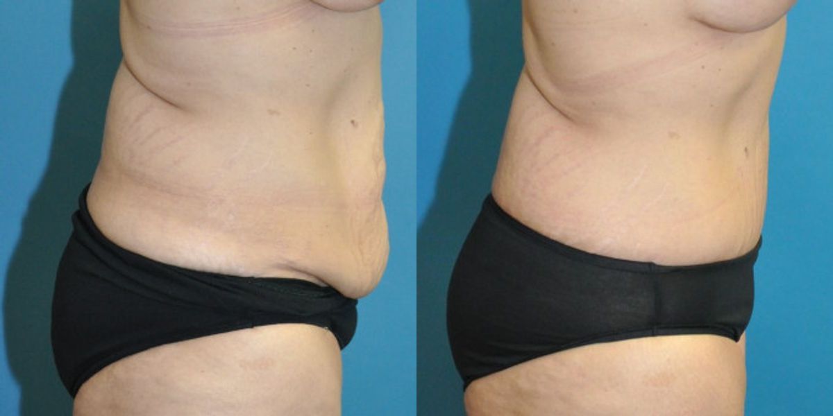 Lower Body Lift #17 - Before and After