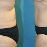 Lower Body Lift #17 - Before and After