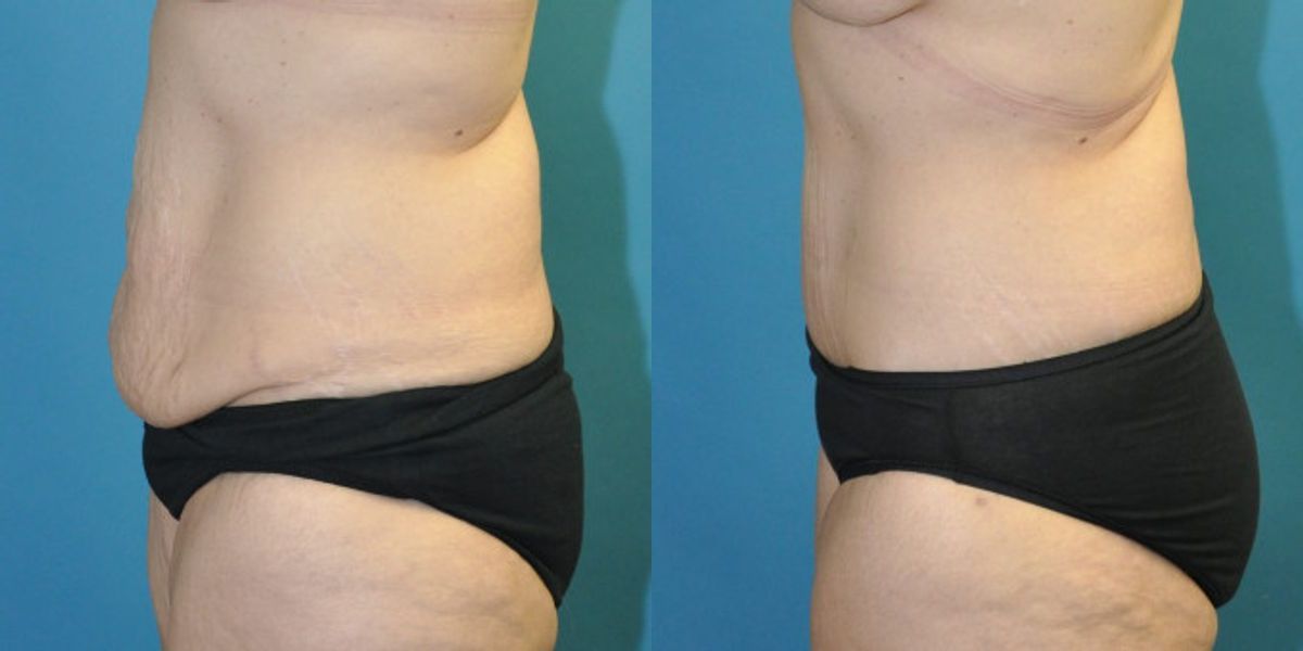 Lower Body Lift #17 - Before and After