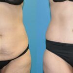 Lower Body Lift #18 - Before and After