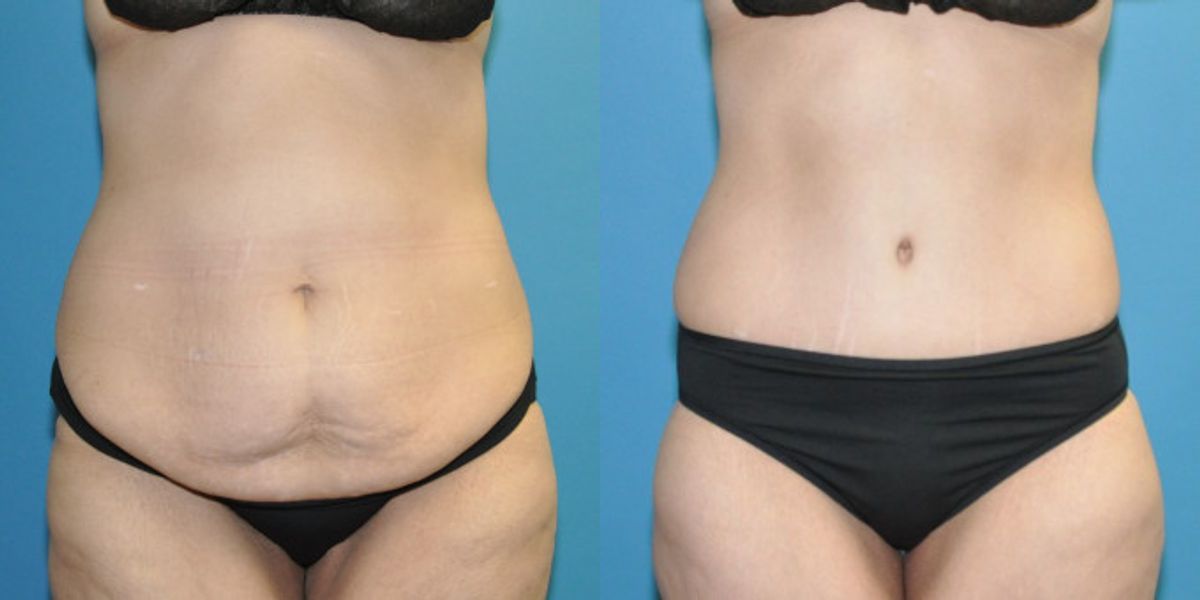 Lower Body Lift #18 - Before and After