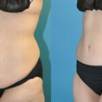 Lower Body Lift #18 - Before and After