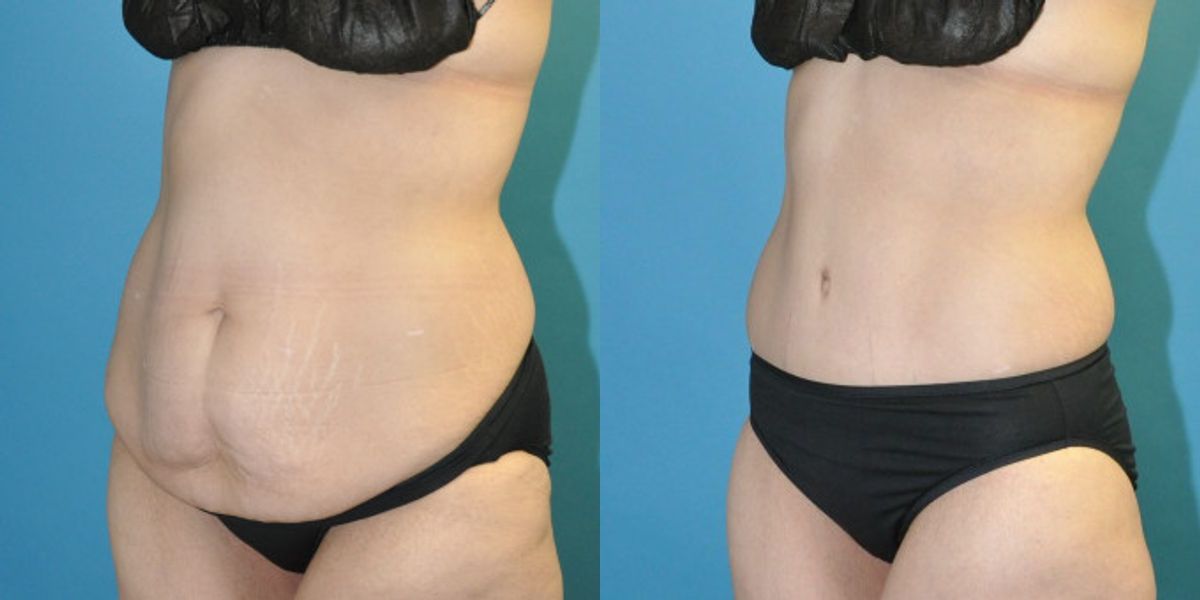 Lower Body Lift #18 - Before and After