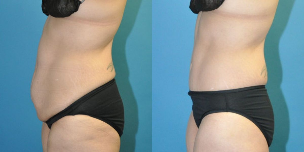 Lower Body Lift #18 - Before and After