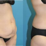 Lower Body Lift #18 - Before and After