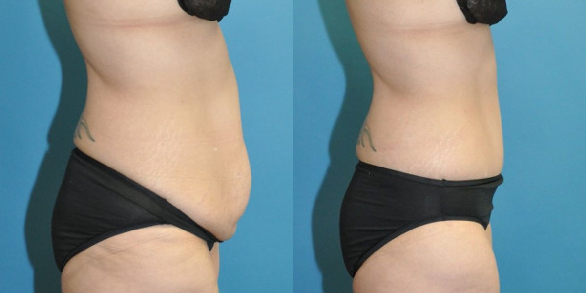 Lower Body Lift #18 - Before and After