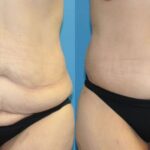 Lower Body Lift #19 - Before and After