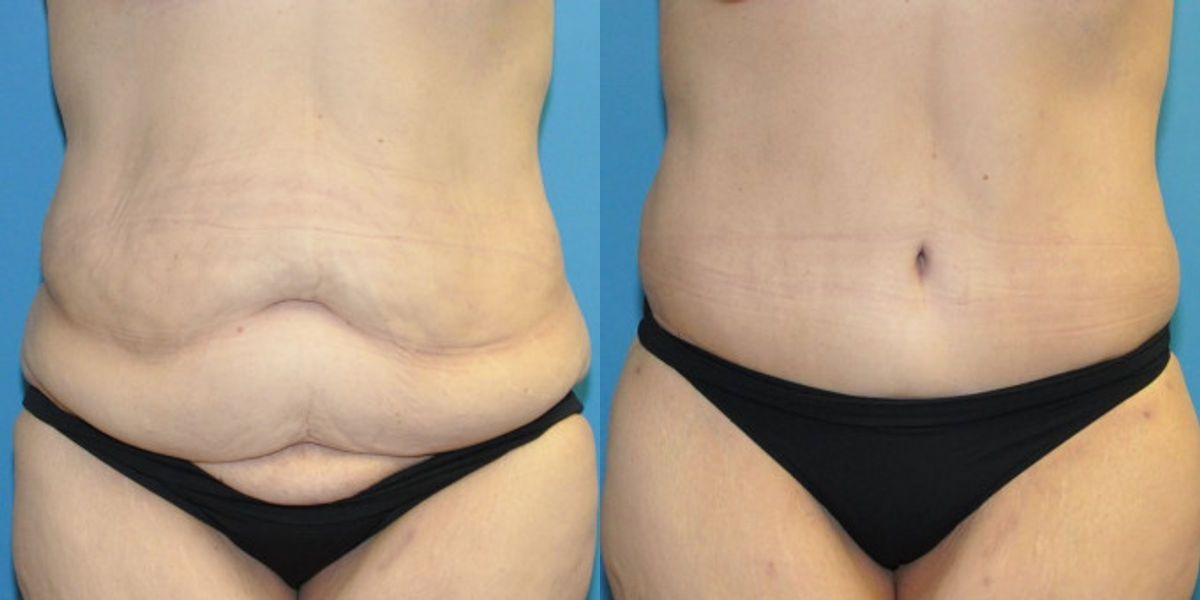 Lower Body Lift #19 - Before and After