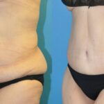 Lower Body Lift #19 - Before and After