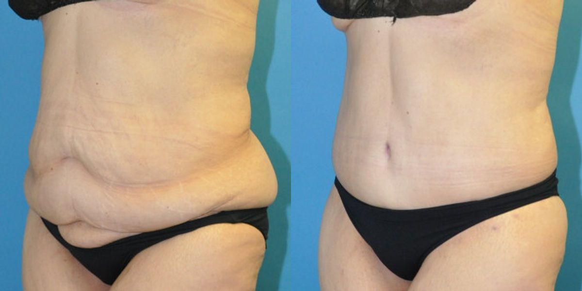 Lower Body Lift #19 - Before and After