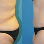 Lower Body Lift #19 - Before and After