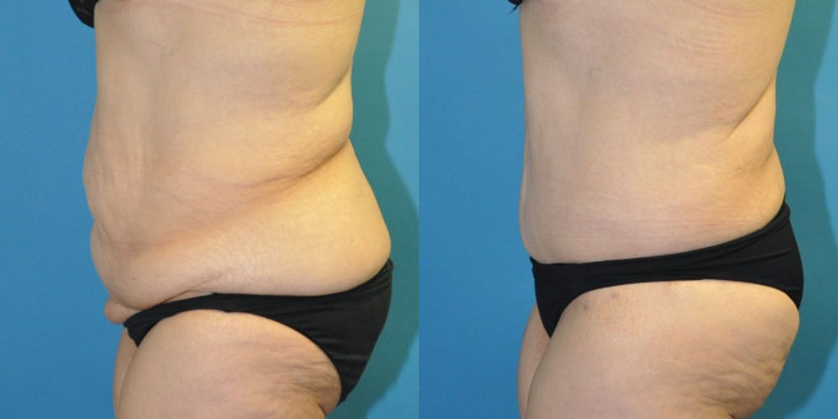 Lower Body Lift #19 - Before and After