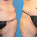 Lower Body Lift #20 - Before and After