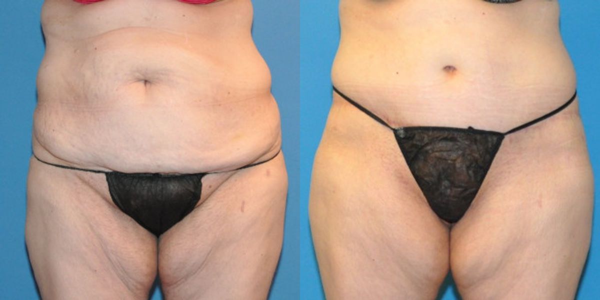 Lower Body Lift #20 - Before and After
