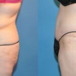 Lower Body Lift #20 - Before and After