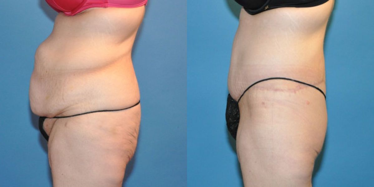 Lower Body Lift #20 - Before and After