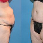 Lower Body Lift #20 - Before and After