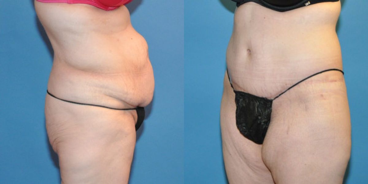 Lower Body Lift #20 - Before and After