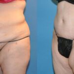 Lower Body Lift #20 - Before and After